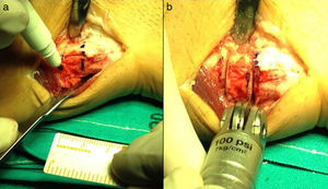 Marking of osteotomy level (at 10–15mm of the distal joint surface of the ulna) also correcting ulnar variance (a). Resection of 10mm of the distal portion of the ulna with an oscillating saw (b).
