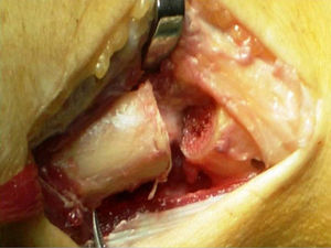 Segmental osteotomy of the distal ulna.