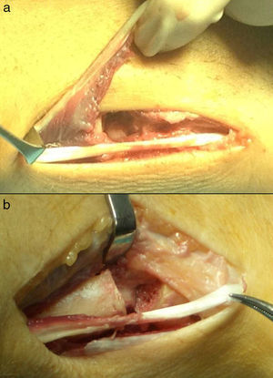 Obtention of an extensor carpi ulnaris hemitendon through distal section (a and b).