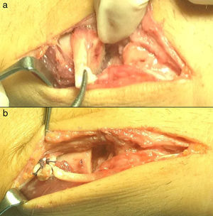 Interposition plasty with extensor carpi ulnaris hemitendon as a “tie” or “scarf” on the proximal ulnar stump (a) and suture of the hemitendon on itself (b).