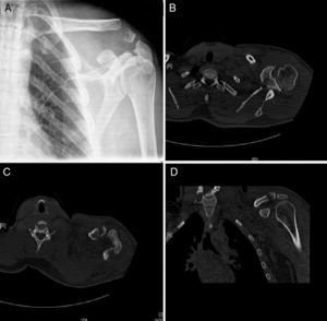 (A) Plain radiograph of the left shoulder revealing an Ogawa type I fracture of the coracoid process, a Kuhn type III fracture of the acromion and a Neer type II fracture of the clavicle. (B–D) Computed tomography scan of the left shoulder confirming the diagnosis.