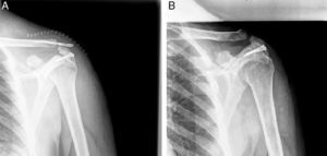 (A) Postoperative control radiograph showing a good reduction of the fracture. (B) Control radiograph showing satisfactory consolidation of the fractures.
