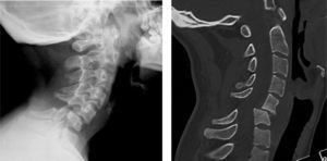 Lateral radiograph of the cervical spine and computed tomography scan showing dislocation of an articular facet and subluxation of the other between C5–C6.