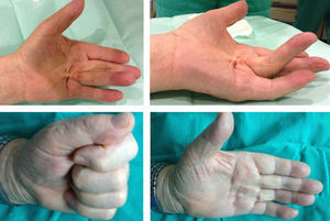 Dupuytren's disease in fourth finger prior to the administration of CH collagenase and at 1 month after administration.