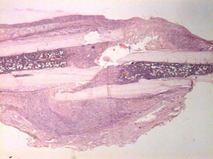 Microscopic aspect of the facture callus in a studied sample.
