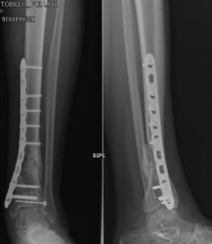 Posttraumatic osteoarthritis secondary to high-energy fracture of the tibial pilon.