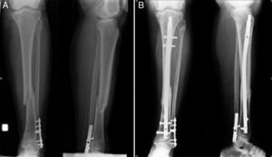 (A) Tibial diaphyseal fracture. The osteosynthesis material of the distal fibula with a consolidated fracture can be observed. (B) Six months postoperatively.