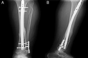 (A) Peri-implant fracture of the distal tibia (AP projection). (B) The distal locking screw can be seen outside the intramedullary nail.