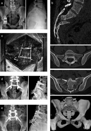 Images from a 24-year-old female patient who suffered an autolytic fall. (a) Simple radiograph showing a transverse sacral fracture with flexion and antepulsion of the distal fragment. (b) CT scan showing an H-shaped fracture of the sacrum with SP dissociation. She presented perineal hypoesthesia, fecal incontinence and urinary retention. The patient underwent surgery within 48hours of admission. (c) A bilateral, decompressive laminectomy, from L5 to S3, was performed by a direct posterior approach to the sacrum and last lumbar segments, as well as partial reduction of the fracture and SP fixation with L4, L5 and iliac pedicled screws and double longitudinal bars with transverse reinforcement. Since we achieved adequate decompression with this action and did not have complete control of the distal sacral fragment, we did not opt for complete anatomical reduction in order to avoid possible morbidity resulting from manipulation. We associated posterolateral arthrodesis with an iliac crest autograft. (d) Satisfactory postoperative radiographic control. (e) Control at 7 months after surgery, showing fracture consolidation and arthrodesis of the L4-S1 levels. In the annual control, the patient was able to walk without aids and pain, presenting residual perineal hypoesthesia and an acceptable sphincter control, although mild urinary dysfunction persisted.