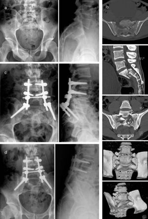 Images from a 25-year-old male patient who suffered an accidental fall. (a) Plain radiographic images showing a transverse fracture of the sacrum with flexion and retropulsion of the distal fragment. (b) The CT scan showed a U-shaped fracture of the sacrum with SP dissociation. The patient presented mild paresis of the left lower limb and an adequate sphincter control. The patient underwent surgery within 48h of admission. Bilateral, decompressive laminectomy of the L4-S1 levels was performed by a posterior approach. As in the previous case, due to the appropriate decompression achieved and difficulty to control the distal sacrum, we chose to accept a partial reduction of the fracture. We conducted SP fixation with lumbar L3-L4 and iliac pedicled screws joined by longitudinal bars with a single cross brace. We associated a posterolateral arthrodesis with iliac graft. (c) Satisfactory postoperative radiographic control. (d) Control at 1 year after surgery showing fracture consolidation and fusion of the L3-S1 levels. In the annual control the patient was able to walk unaided, with moderate low back pain which could be related to the prominence of the osteosynthesis material. He also had complete control of sphincters.