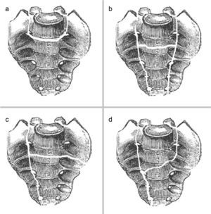 Morphological classification. Description of the shape of the fracture lines in the sacrum, in the coronal plane. (a) U-shaped fracture. (b) H-shaped fracture. (c) T-shaped fracture. (d) Y-shaped fracture.