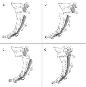 Modified Roy-Camille classification. Relationship between sacral fragments in the sagittal plane. (a) Type I: angulation in kyphosis without displacement. (b) Type II: angulation with partial anterior displacement. (c) Type III: angulation with complete displacement. (d) Type IV: S1 segmental comminution.