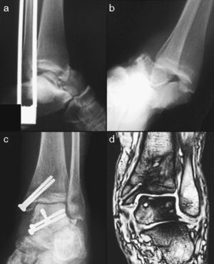 Image from a 31-year-old female suffering Hawkins type II talar neck fracture caused by a traffic accident (A and B). Radiographic control at 8 weeks after the trauma with no Hawkins sign (C). Magnetic resonance imaging scan showing avascular necrosis of the astragalus (D).
