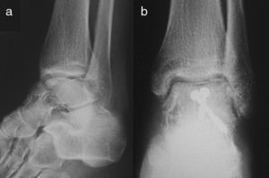 Image from a 38-year-old male suffering Hawkins type II talar neck fracture caused by a fall (A). Radiographic control at 6 weeks after the trauma showing positive Hawkins sign (B). The patient did not suffer necrosis of the astragalus.