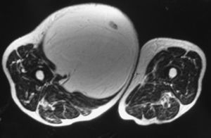 Axial section of an MRI scan of an IM lipoma in the anterior compartment of the thigh.