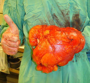 Resection specimen of the case in Fig. 2, excised with marginal margins. The image shows the large size of the tumor compared to the hand of the surgeon. Excellent clinical result and absence of recurrence at 6 years after the surgical intervention.
