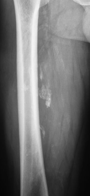 AP radiograph of the thigh with an intramuscular lipoma in its posterior compartment, showing calcified areas.
