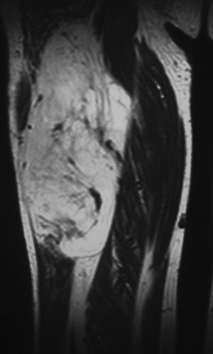 Coronal section of an MRI scan of the case in Fig. 4, showing multiple gross and irregular septa which lead to suspicion of low-grade liposarcoma. Excellent clinical result and absence of recurrence at 5 years after the surgical intervention.