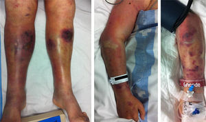 Condition of soft tissues. Upon admission, the patient presented bruising and swelling in the legs, which worsened gradually, along with the appearance of phlyctenas with hemorrhagic content. Subsequently, the same symptoms began to appear in the upper limbs.