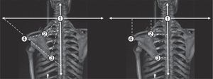 Distances and angles after medially rotating the inferior angle of the scapula. It is possible to observe the change in the distances and angles formed in the model, correlating with medial movement of the inferior angle of the scapula. Point 1: C7 vertebra; point 2: medial edge of the scapular spine; point 3: inferior angle of the scapula, and point 4: posterior aspect of the acromion.