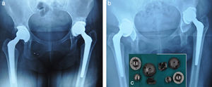 (a) Follow-up X-ray (from 2005) with separation of the reticular component of both cups and radiolucence lines on acetabular zones i and ii, without clinical symptoms. (b) Follow-up X-ray (from 2012) showing bilateral mobilization of the acetabular cup without dislocation but with displacement. Please note the separation of the acetabular porous component. (c) Components mobilized and removed.