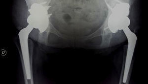 Annual follow-up X-ray showing the correct positioning of the implants with restoration of the rotation centers.