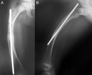 Seven-year-old patient operated on for a deformity of the right femur using the Sofield-Millar technique (A). After 3 years, extrusion of the proximal tip of the nail is observed (B).