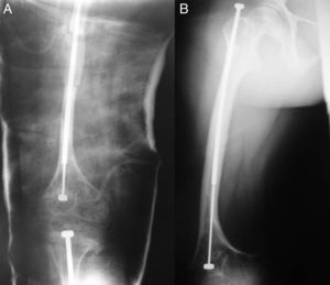 Seven-and-a-half-year-old patient operated on with a telescopic endomedullary nail for correction of a deformity in the femur (A). At age 15, the nail has hardly migrated at all and the shaft has been lengthened to adapt to bone growth (B). The patient did not require reintervention at any time during follow-up.