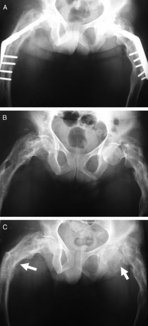 Thirty-year-old patient operated on for a fracture of the 2 proximal femurs with a bilateral screw and plate (A). Three months after removal of the osteosynthesis material she suffered a basicervical fracture of the left femur (B). One year later, the fracture is in pseudoarthrosis and there is a fracture in the contralateral femur. (C) The patient is incapable of deambulation.