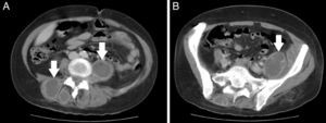 (A) CT scan showing the paravertebral abscesses (arrows). (B) CT scan showing the abscess at the level of the left iliopsoas muscle.