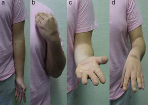 Images (a) and (b) show an elbow extension of −5° and flexion of 125°. Images (c) and (d) show supination of −10° and full pronation.