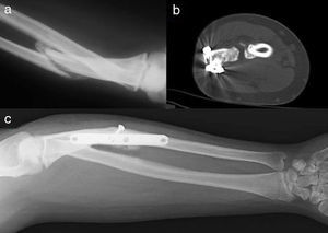 Image (a) shows the synostosis secondary to ulnar malunion and (b) shows the postoperative CT revealing the bone separation in the area of synostosis. Image (c) shows the postoperative radiograph with correct consolidation without recurrence of synostosis.