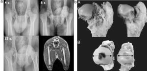 (a) Sequential radiographic study at 4, 8 and 12 postoperative weeks. An enlargement and flattening of the femoral head can be observed, becoming more evident at 12 weeks. The MRI scan shows a flattening and lateral subluxation of the femoral head. (b) Macroscopically, we observed hypertrophy and a progressive flattening of the femoral head in the experimental group relative to the control group, from week 4 to week 12 after the intervention.