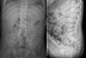 Plain radiographs, in the anteroposterior and lateral projections, of a 14-month-old patient suffering L4-L5 discitis, obtained 4 weeks after the onset of symptoms.