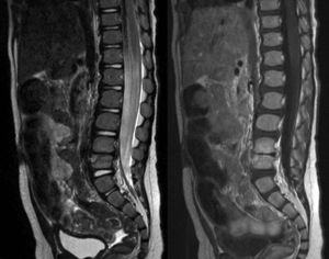 T1 (right) and T2 (left) MRI sections of a 14-month-old patient suffering L4-L5 discitis (same patient as in Fig. 2).