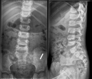 Plain radiographs, in the anteroposterior and lateral projections, of a patient suffering L4-L5 discitis, obtained at 26 months after diagnosis, at an age of 3 years and 4 months (same patient as in Figs. 2 and 3). A decrease in the intervertebral space can be observed, as well as sclerosis of the upper and lower vertebral plates.