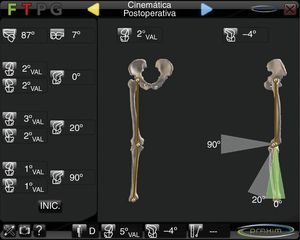 Navigator screen showing variations of the femorotibial angle after implantation of a knee prosthesis.