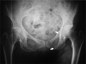 Anteroposterior radiograph of the pelvis showing fractures of the left iliac and ischiopubic rami.