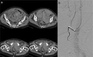 (a) Images from an abdominopelvic CT scan showing the different axial sections of a bilateral retroperitoneal hematoma measuring 10cm×15cm. (b) Supraselective angiography of the external iliac artery and the left and right hypogastric arteries with embolization through three microcoils.