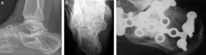 (A–C) Comminuted fracture of the calcaneus in a 35-year-old female patient treated with osteosynthesis and β-TCP beads (Ceraball®). The implant was removed at 22 months after surgery: resorption of the bone replacement and trabecular reconstruction.