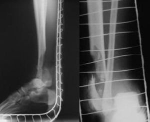 Anteroposterior radiograph and profile in the emergency service.