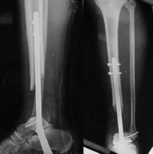 Anteroposterior radiograph and profile showing the postoperative placement of intramedullary nails, as well as the bone defect.