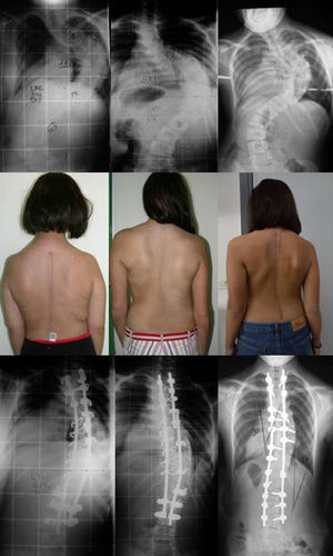 Representative figure of 3 patients with severe idiopathic scoliosis operated by 3 different strategies. The patient on the left was operated by a double approach consisting of release and anterior arthrodesis by thoracolumbotomy and instrumented posterior arthrodesis. The patient in the center was operated using hybrid instrumentation through an isolated posterior approach, and the patient on the right through an isolated posterior approach using only screws. Note the good results obtained in all 3 cases, regardless of the instrumentation and the approach employed.