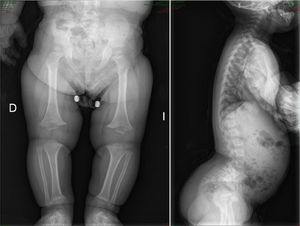 Typical radiological findings in achondroplasia: distal femoral epiphysis in inverted “V” shape, fibula longer than tibia, horizontalization of sacrum, lumbar hyperlordosis.