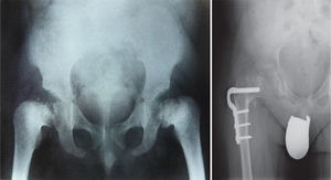 On the left, AP radiograph of the pelvis showing irregular femoral epiphyses with multiple epiphyseal ossification centers, bilateral deformities in coxa vara. On the right, treatment of deformities by valgus and derotatory osteotomy.