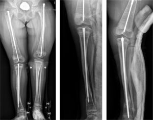 A 7-year-old girl suffering OI with a telescopic Fassier-Duval nailing in both femurs and right tibia. As she grew, the tibial nail caused a periimplant fracture and had to be replaced by a longer one.