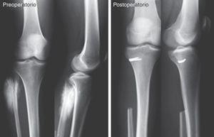 Clinical case. Osteosarcoma of the proximal fibula. Type II Malawer resection and reconstruction of the posterolateral complex of the knee at the level of the tibial metaphysis using a staple.