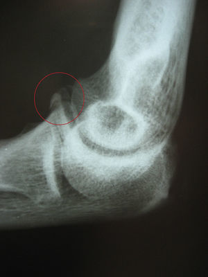 Detail of the previous coronoid fracture.