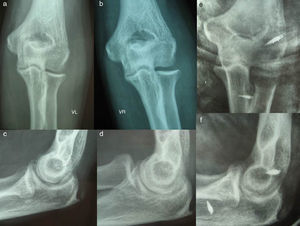 (a–d) Varus instability and subluxation of the radial head. (e and f) The centering obtained after ligament repair surgery.