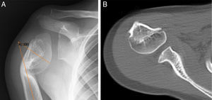 (A) Radiographic study showing varus deformity of the surgical neck of the humerus with closure of the medial growth plate and a neck-diaphysis angle of 50°; (B) CT study with humeral head remodeling.